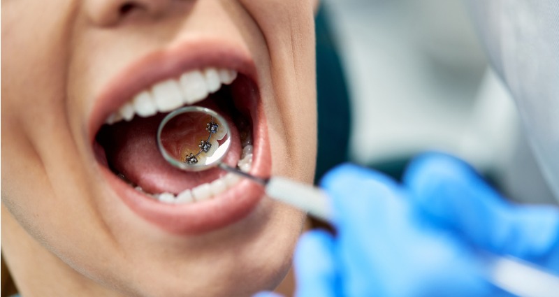 Correcting an overbite - Morley Orthodontic Clinic