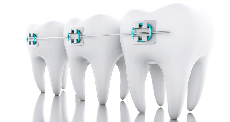 Broken Braces? What to do if a Bracket or Wire Breaks (Don't Panic!)