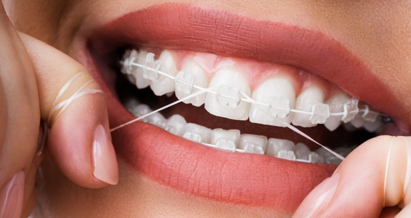 How to Fix a Broken Braces Wire: 6 Simple Ways