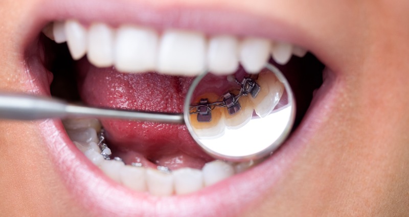 Orthodontics Australia  Different Types Of Braces for Teeth