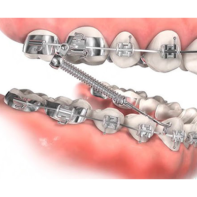 Fixed Bite Correctors to Treat Your Bite Discrepancy